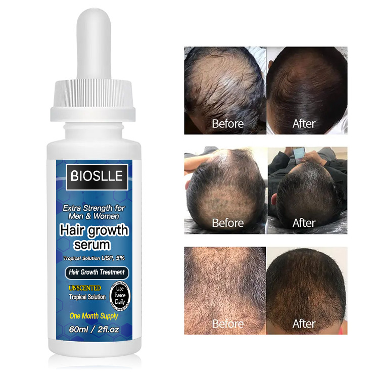Minoxidil Hair Growth Serum for Men and Women Tropical Solution USP